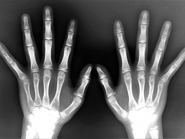 骨粗鬆症のイメージ画像