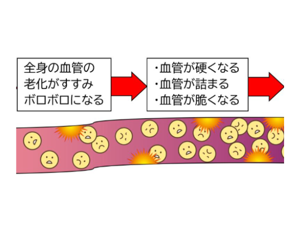血管が硬くなるイメージ画像